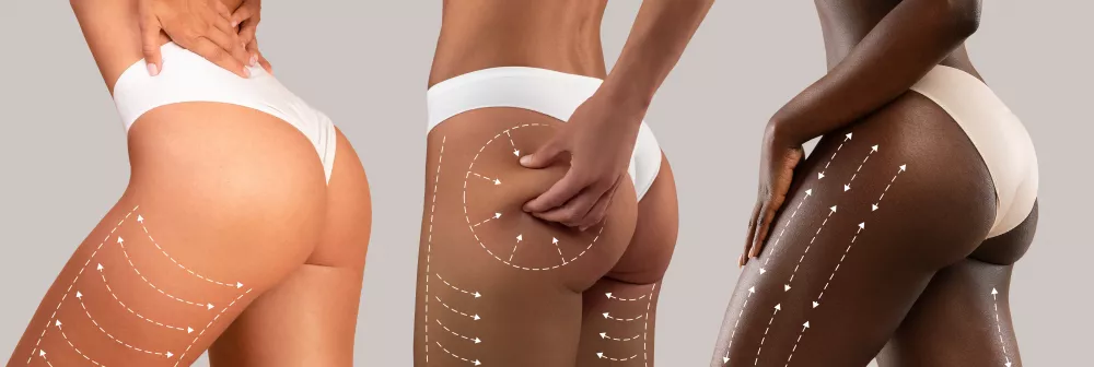 quanto dura il filler ai glutei