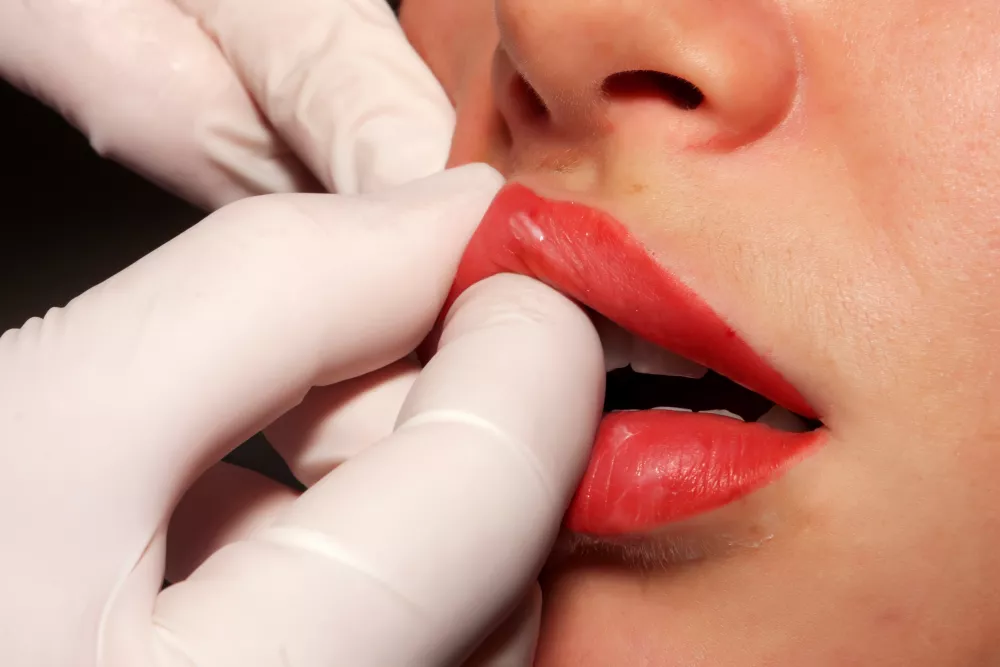 filler labbra