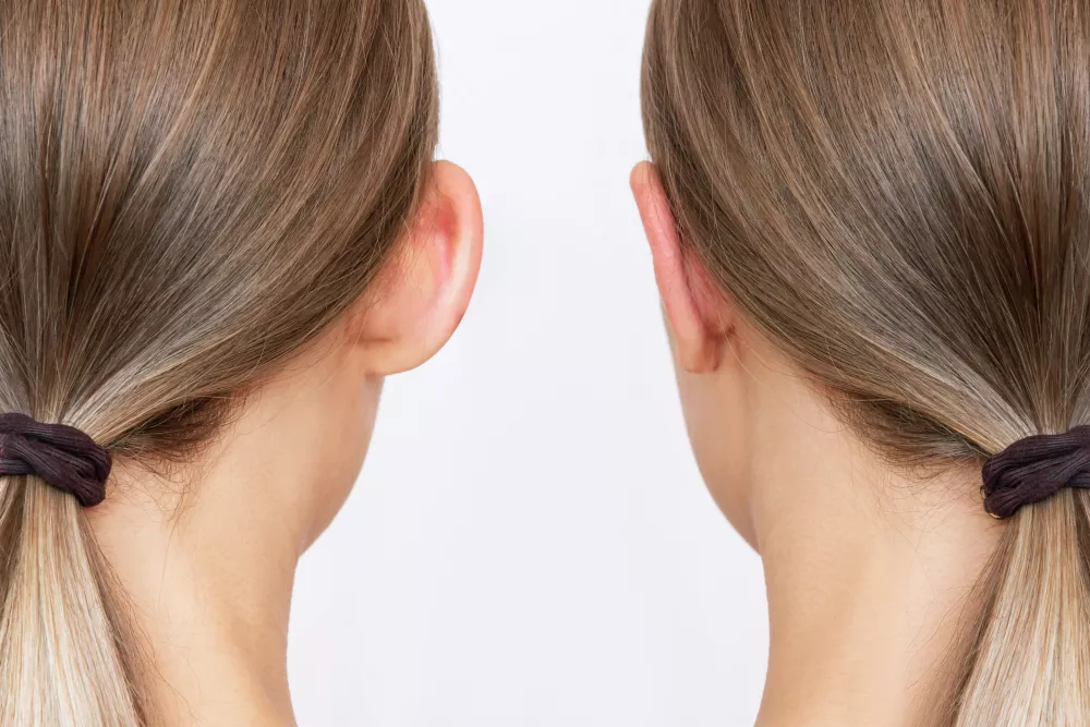 cosa significa otoplastica