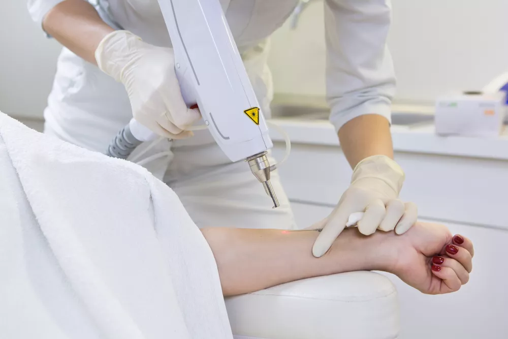  rimozione tatuaggi 