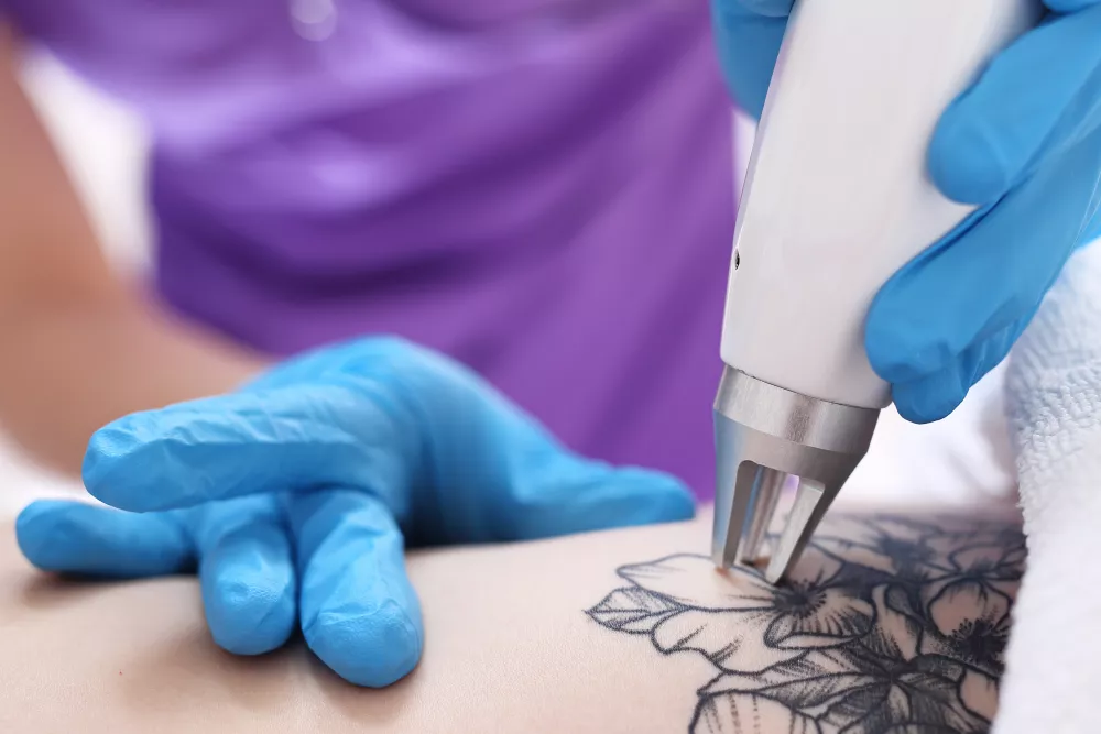 quante sedute per rimuovere tatuaggi 