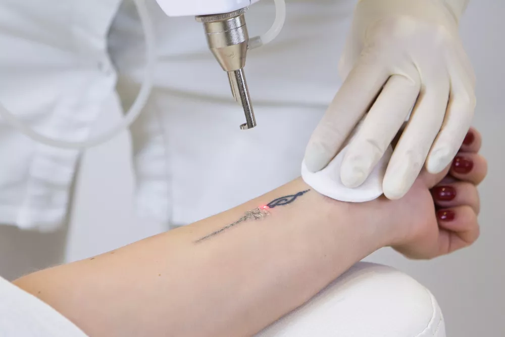 quando togli un tatuaggio resta il segno