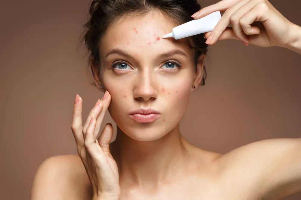che cos'è l'acne