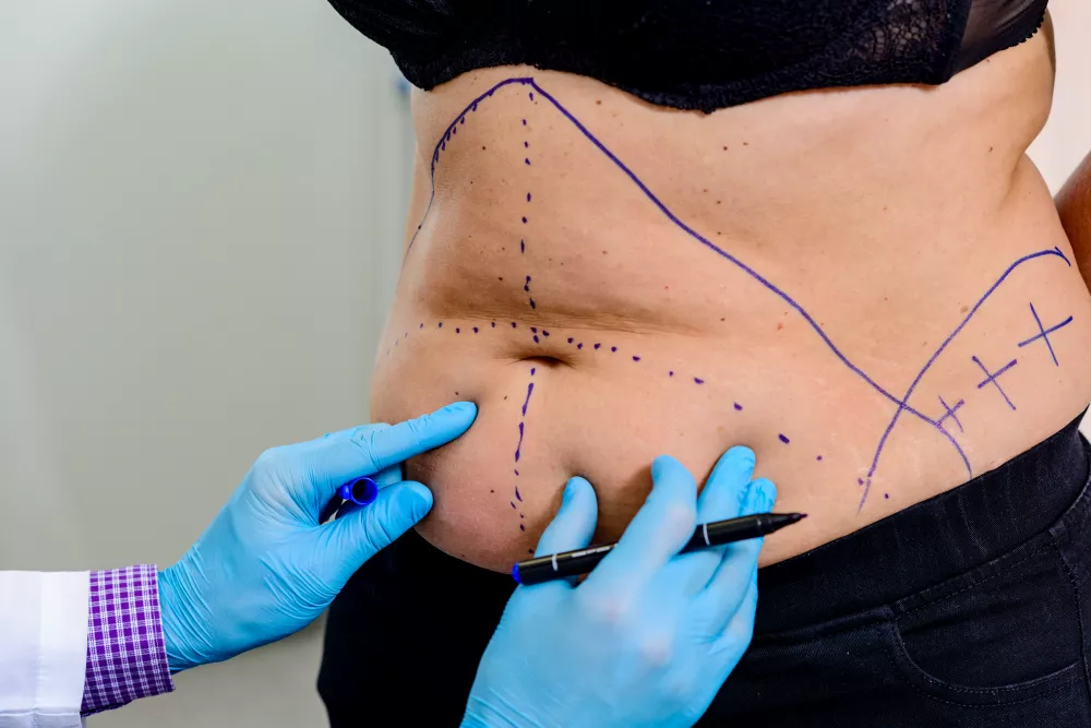 Quali sono i rischi di una liposuzione