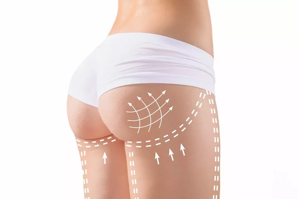 quanto dura l'effetto del lipofilling