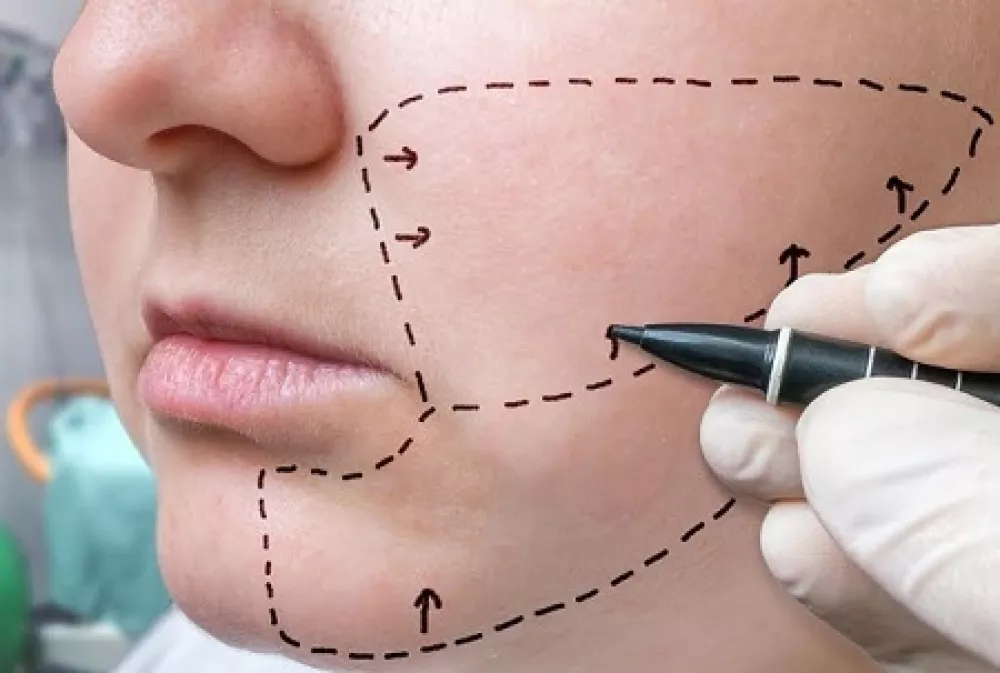 quanto grasso serve per il lipofilling