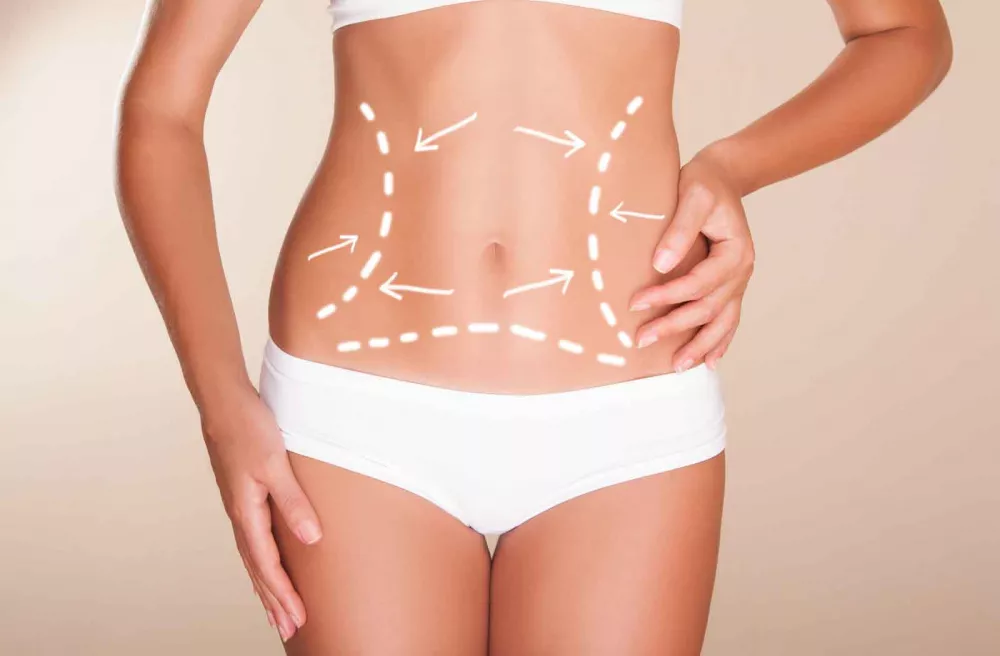in che cosa consiste la liposcultura