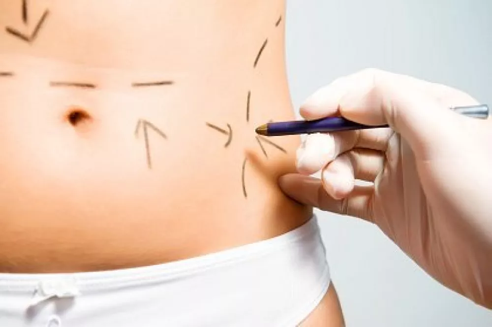 differenza tra liposcultura e liposuzione