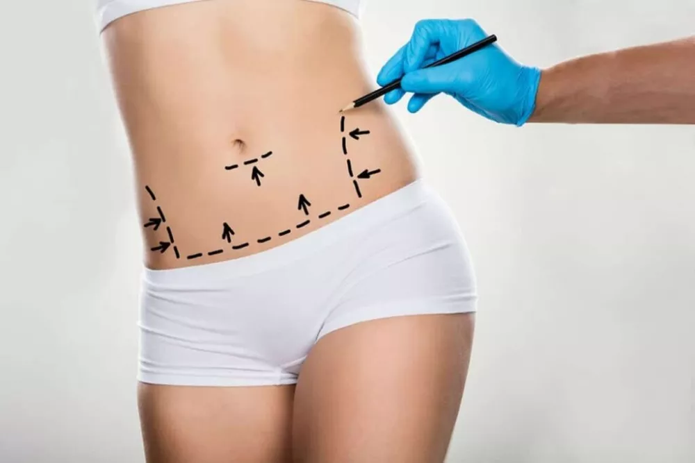 quanto costa intervento liposcultura