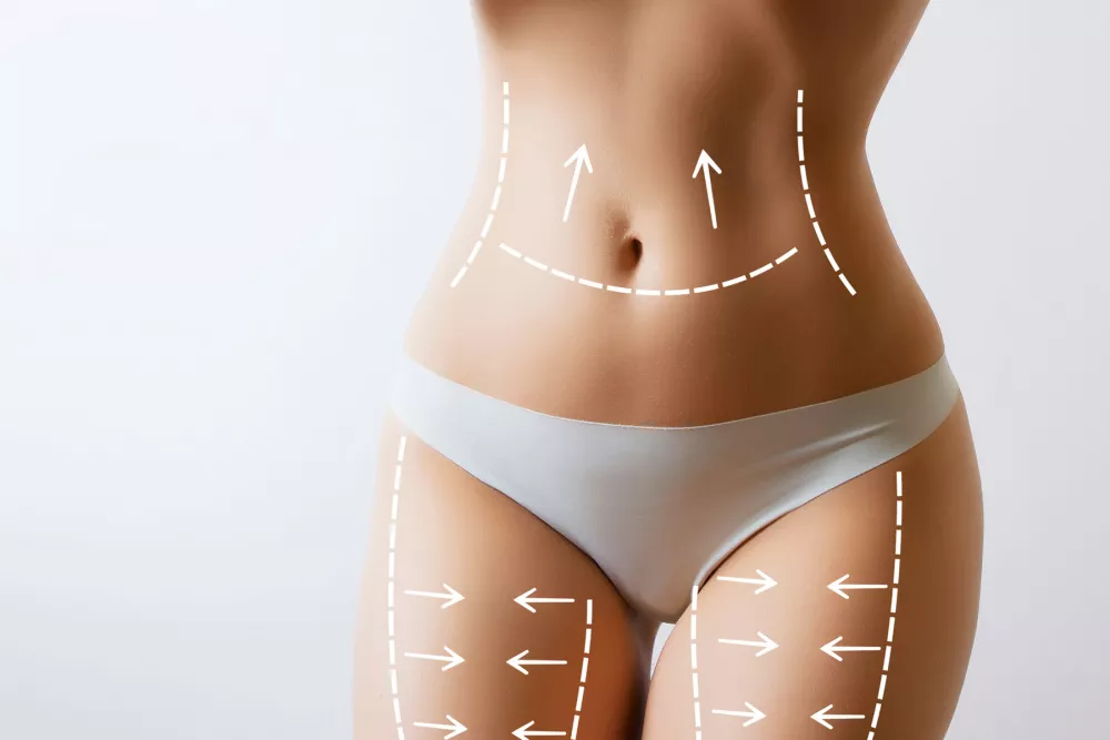 liposuzione laser