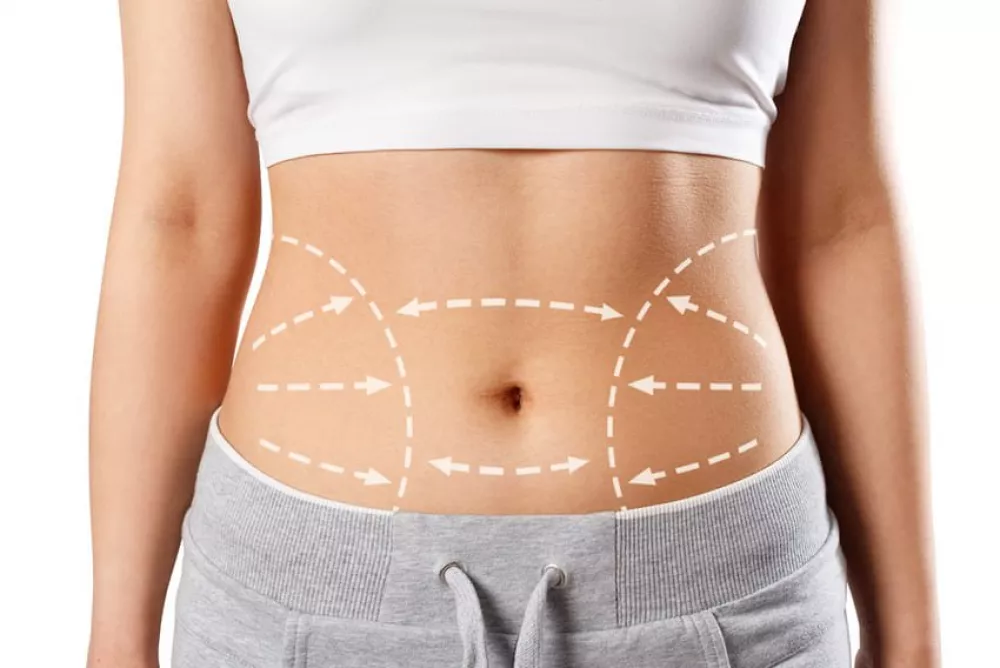 liposuzione non chirurgica